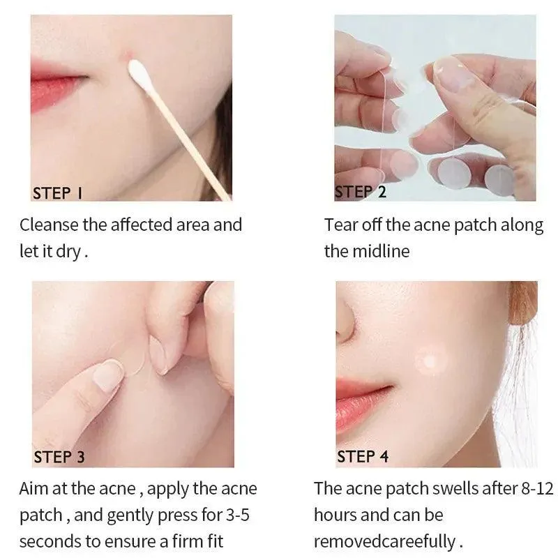 Advanced Hydrocolloid Acne Healing Patches for Rapid Clear Skin Restoration